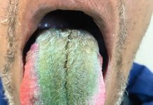 Smoker’s tongue turns green, spouts hair after rare reaction