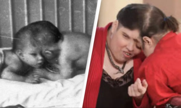 World's Oldest Conjoined Twins George And Lori Have Died Aged 62 ...